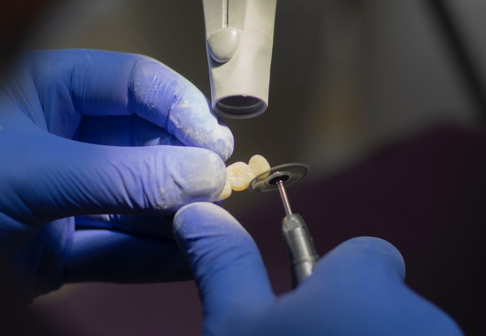 Do you need a crown after a root canal?