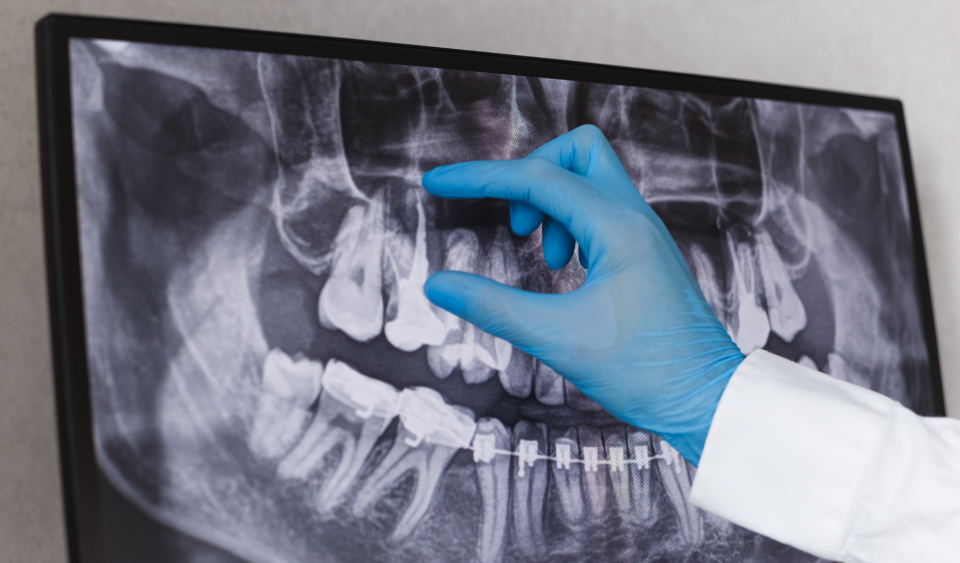 how do you know if you need a root canal